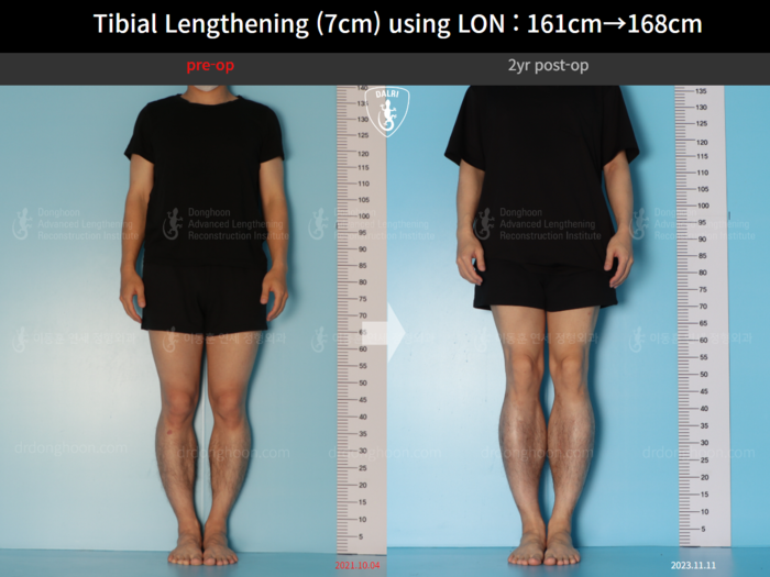 Tibial lengthening, 7 cm gained