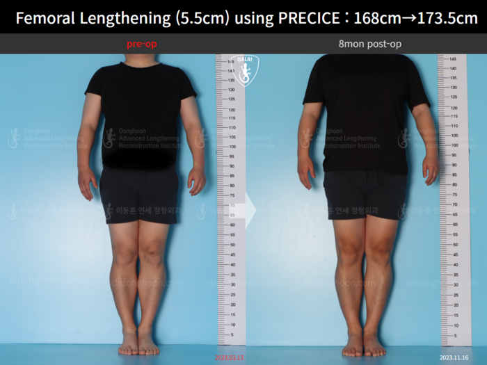 ยืดกระดูกต้นขา เพิ่มขึ้น 5.5 ซม.