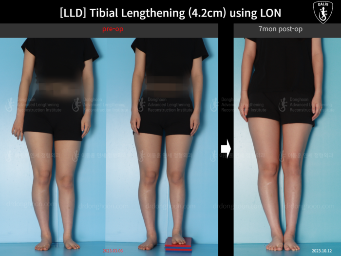 Tibial lengthening, 4.2 cm gained