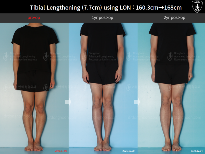 Height increase (limb lengthening) before and after radiograph example 2