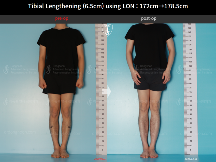 Tibial lengthening, 6.5 cm gained