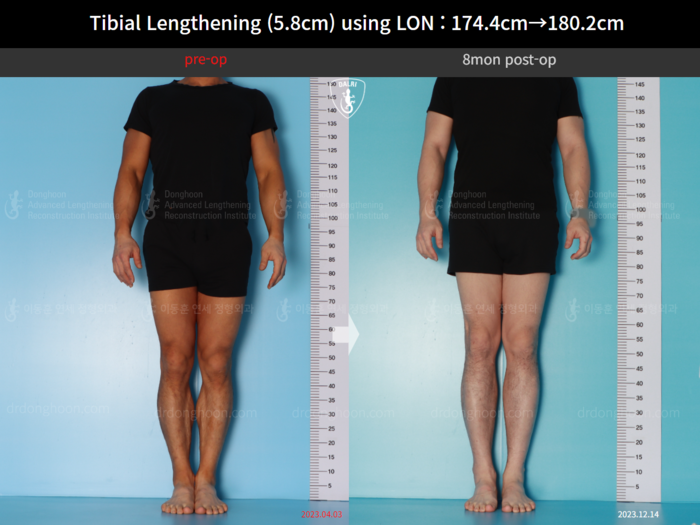 Tibial lengthening, 5.8 cm gained