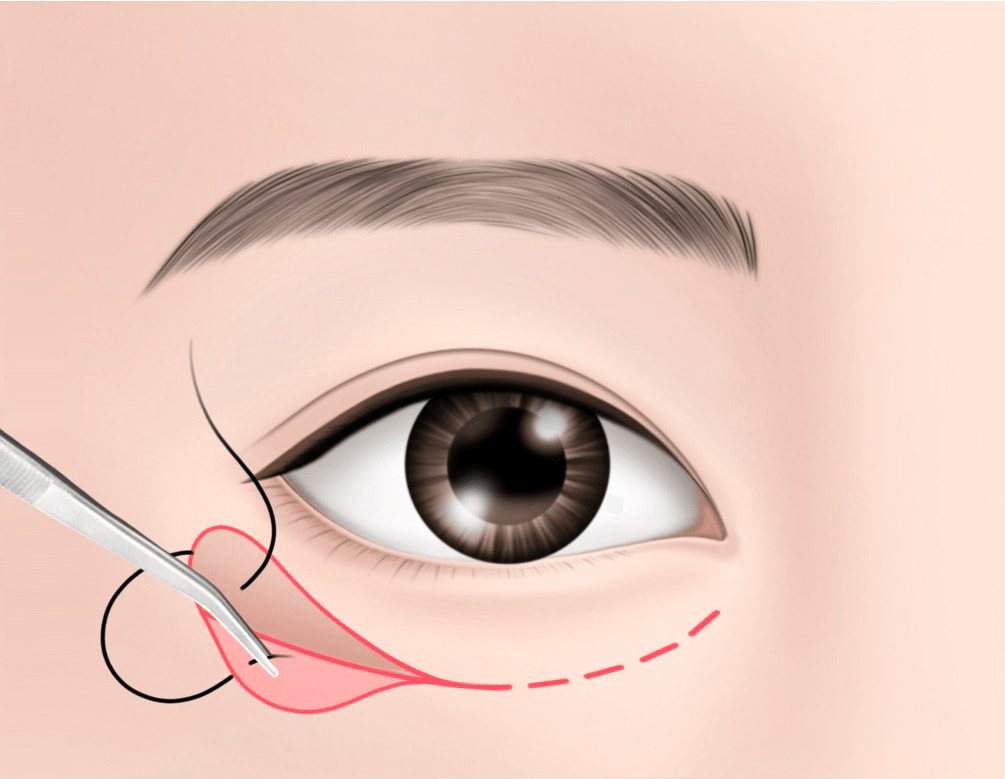눈둘레근 뼈막 걸기