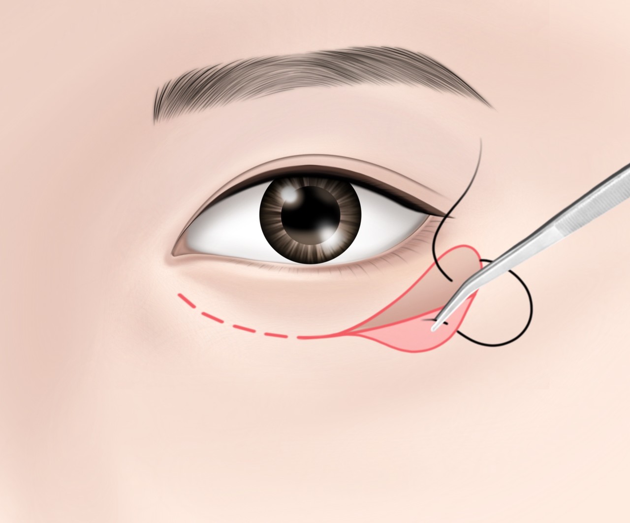 눈둘레근 뼈막 걸기