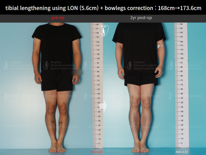 tibial lengthening using LON (5.6cm) + bowlegs correction : 168cm→173.6cm : 2yr post-op