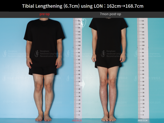 Tibial lengthening, 6.7 cm gained