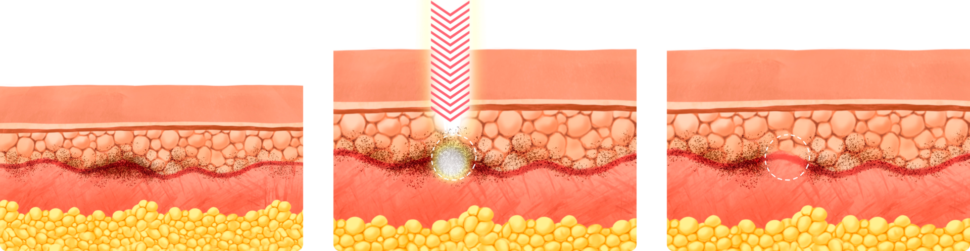 기존 레이저(나노초)보다 더 빠르고 강한 피코 레이저