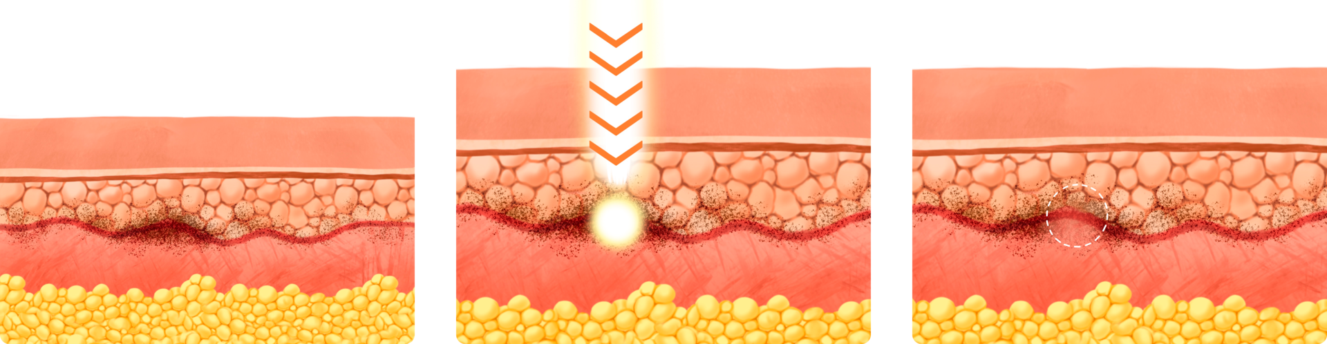기존 레이저 (나노초)