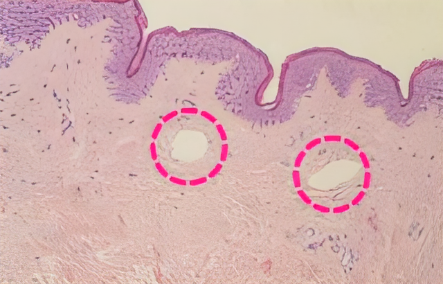 LIOB - Laser Induced Optical Breakdown <br> 레이저가 유도한 광학적 손상이란 뜻으로 피부 안쪽에 생긴 공동화 현상