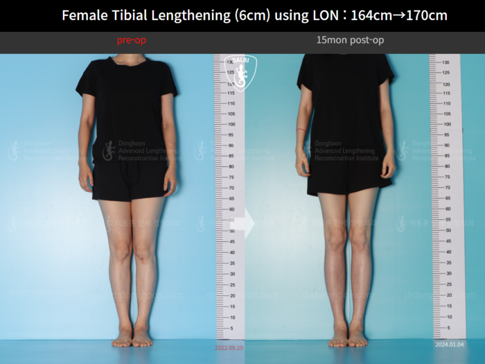 Tibial lengthening, 6 cm gained