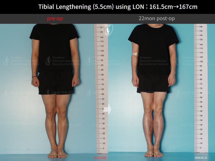 Tibial lengthening, 5.5 cm gained