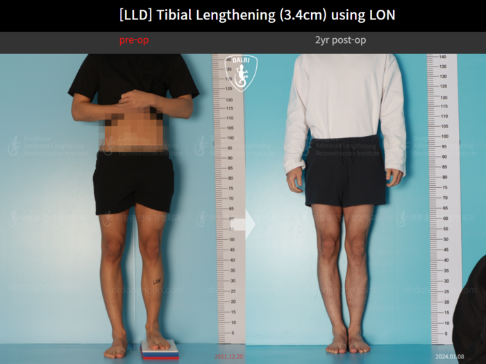Tibial lengthening, 3.4 cm gained