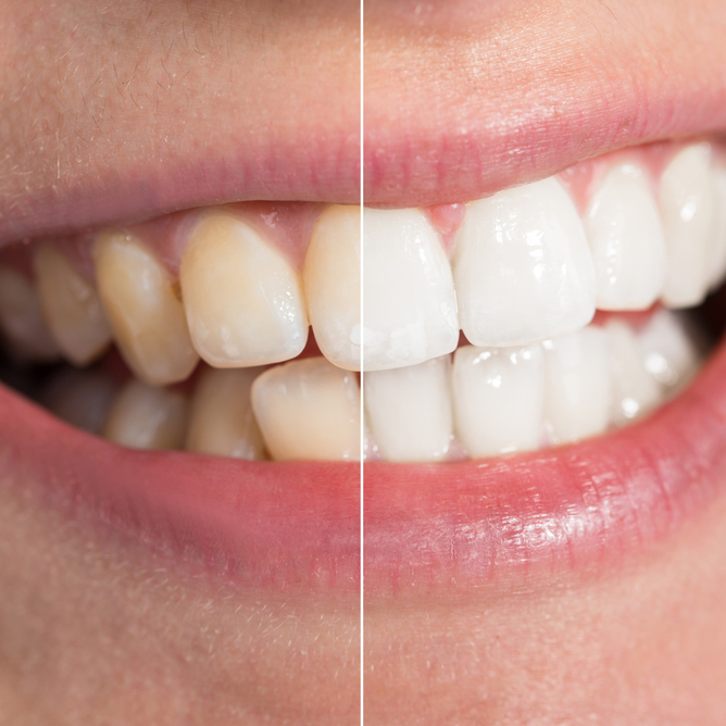 Plastic Surgery / Whitening<br><br><span style="font-size:35px; font-weight:600;">치아성형미백</span>