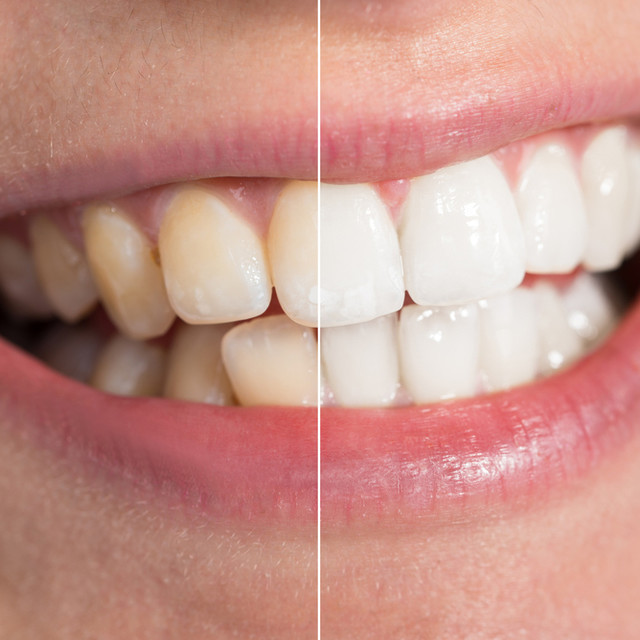 Plastic Surgery / Whitening<br><br><span style="font-size:45px; font-weight:600;">치아성형미백</span>