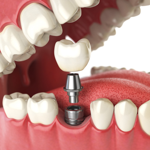Implant<br><br><span style="font-size:45px; font-weight:600;">임플란트</span>