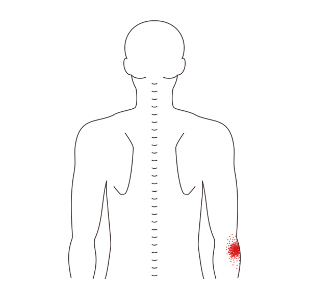 팔꿈치 통증이 나타나는 위치를 표현한 이미지