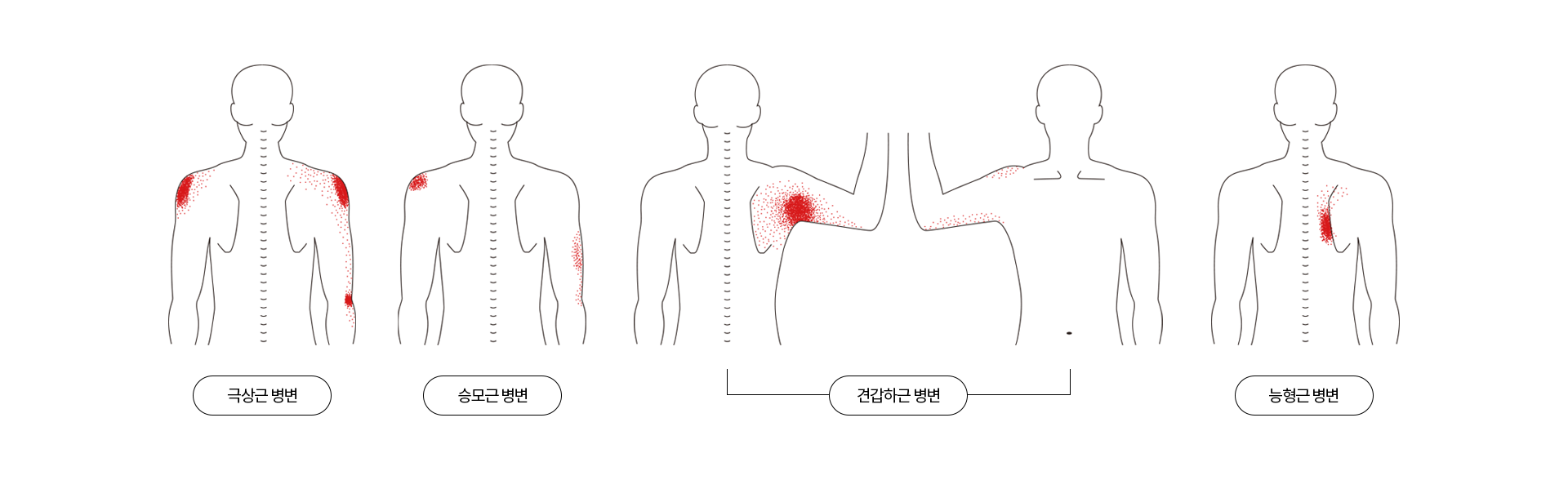 어깨 통증 증상이 나타나는 위치를 표현한 이미지들