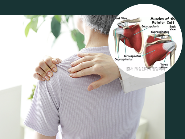 회전근파열을 나타내는 사진