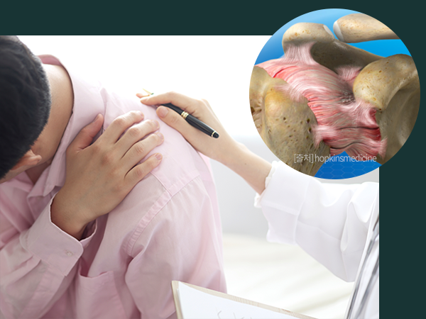 오십견을 표현한 사진