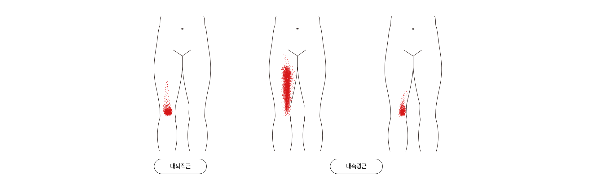 무릎 통증이 나타나는 위치를 표현한 이미지