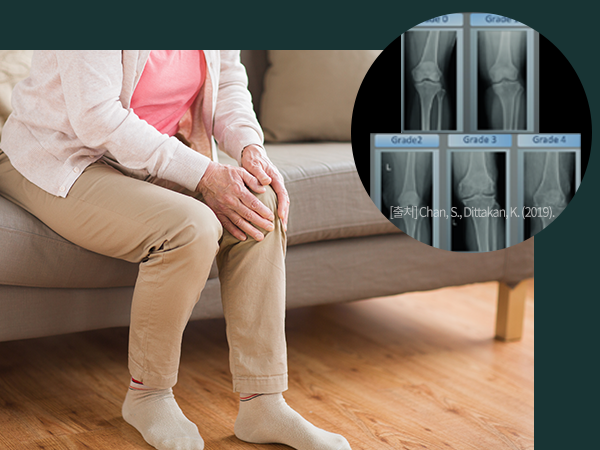 소파에 앉아 무릎 통증을 느끼고 있는 여성의 사진