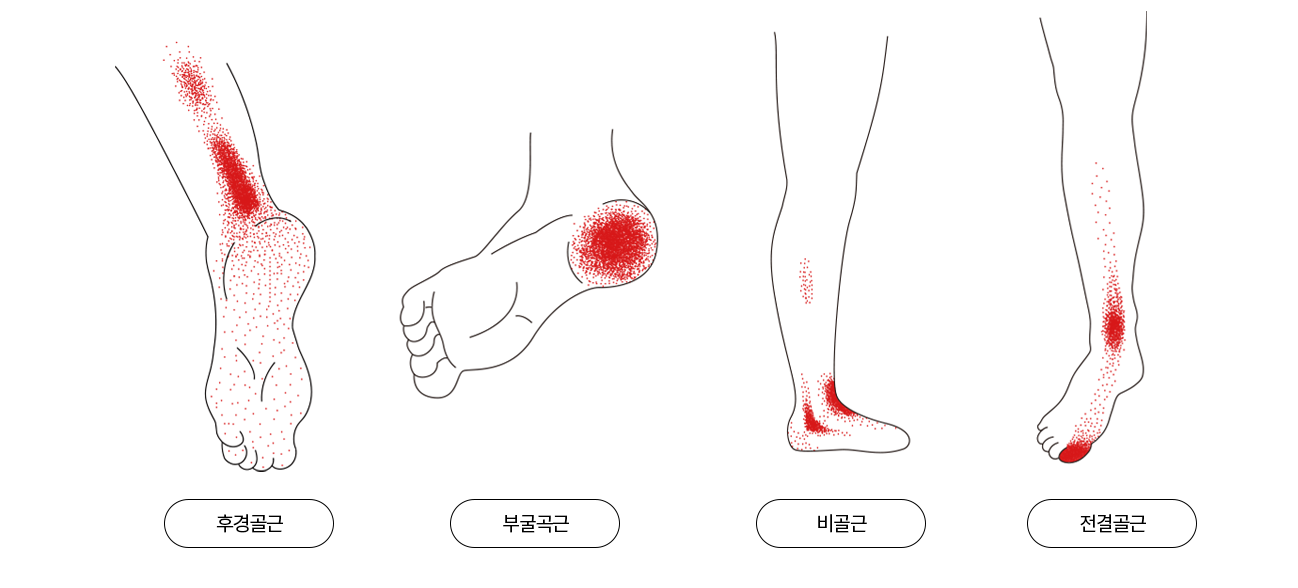 발, 발목 통증이 나타나는 위치를 표현한 이미지