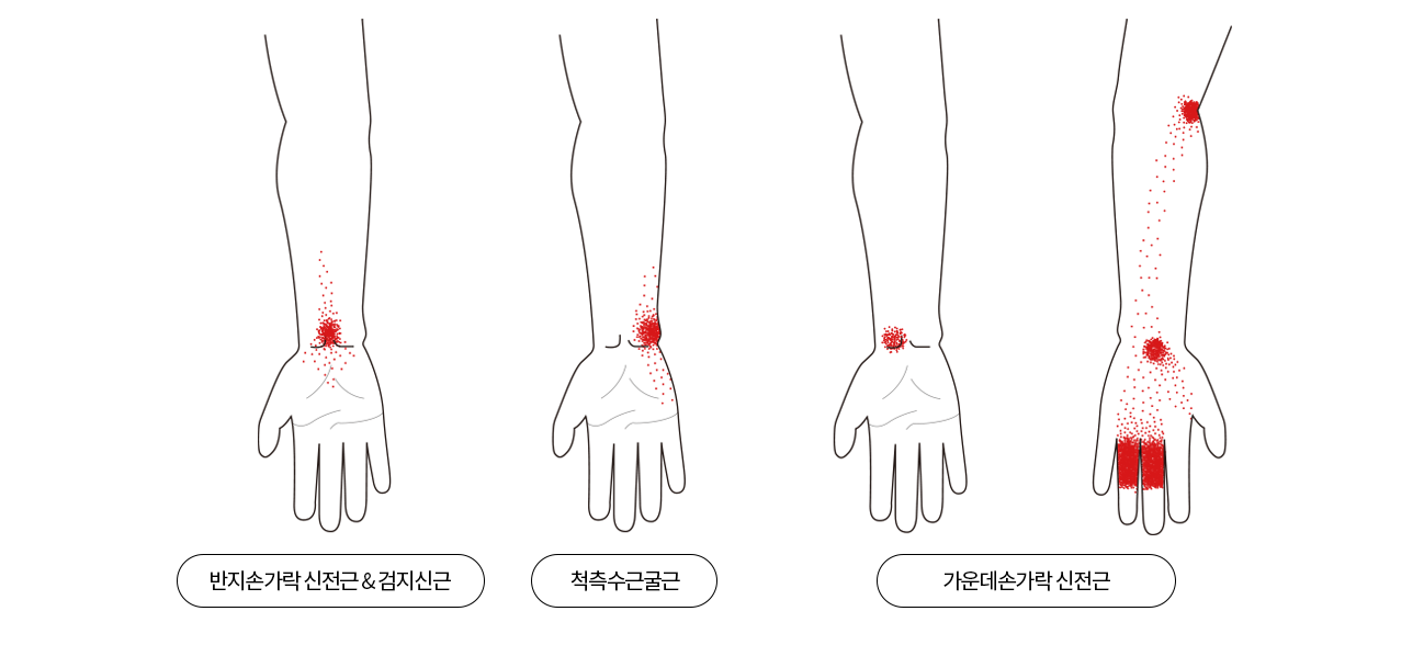 손목, 손 통증을 유발하는 위치를 표현한 이미지