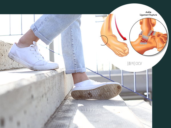 발목을 접지른 여성의 사진