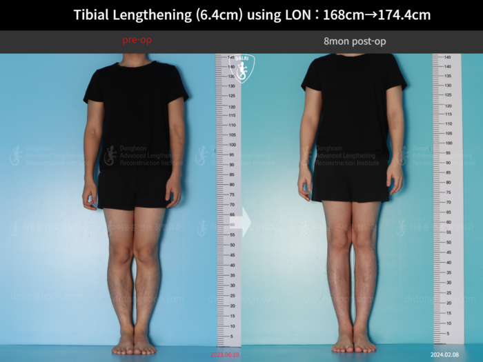 Tibial lengthening, 6.4 cm gained