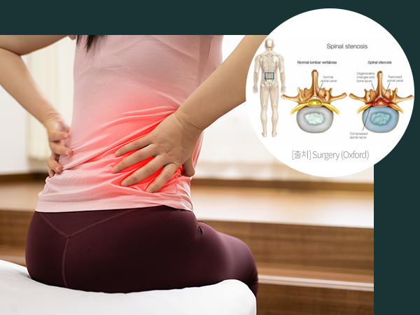 허리협착증을 나타내는 사진