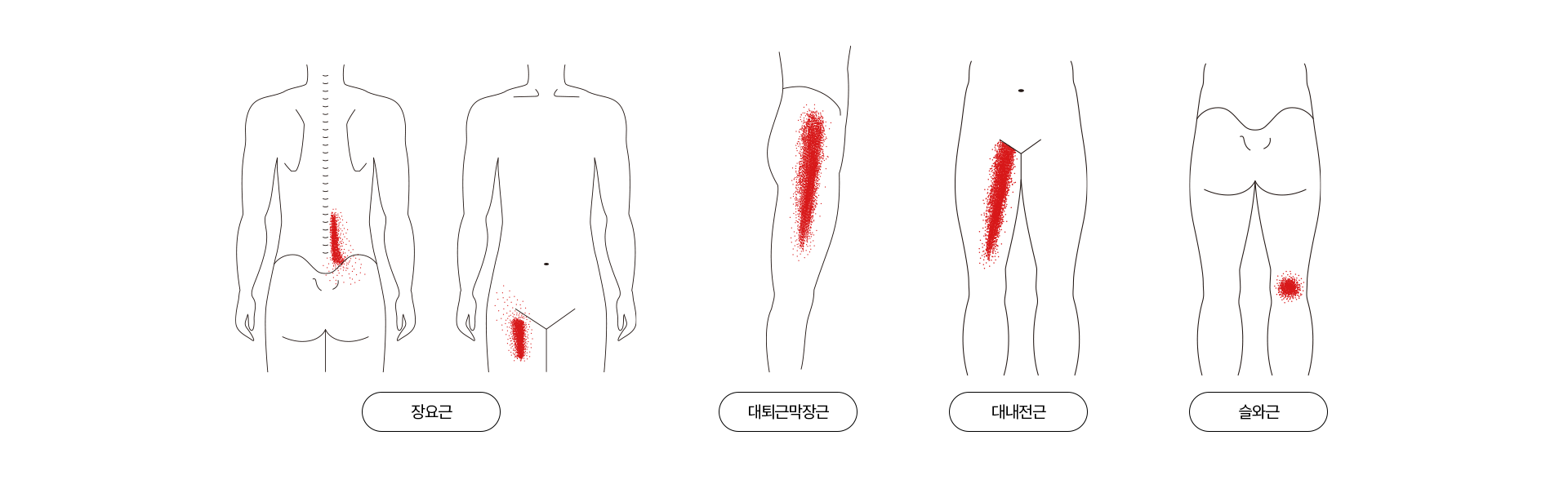 골반 통증 증상을 유발하는 근육의 위치를 나타내는 이미지