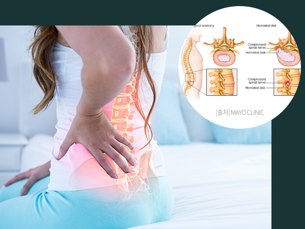 허리디스크를 나타내는 사진