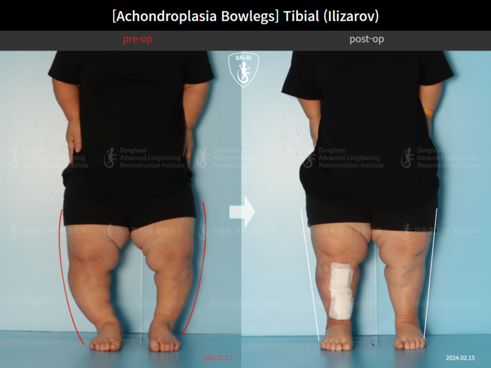 Tibial lengthening