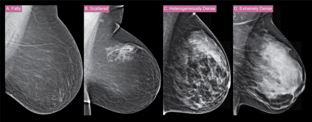 유방 x-ray(mammogram)