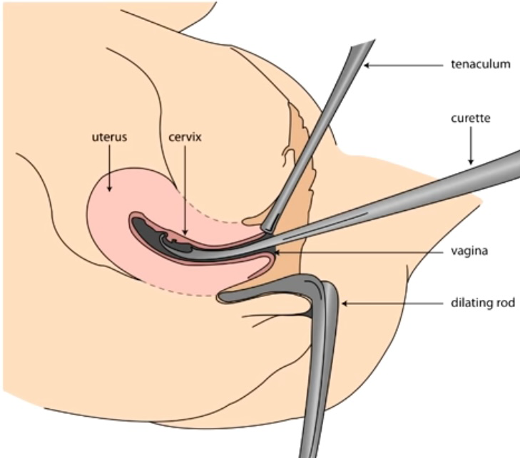 치료적 소파수술