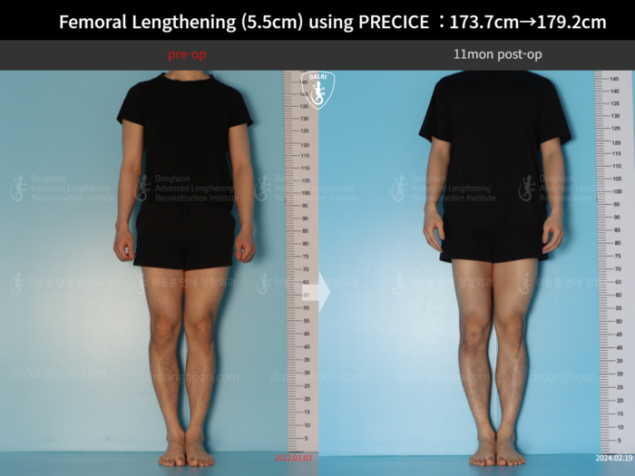 ยืดกระดูกต้นขา เพิ่มขึ้น 5.5 ซม.