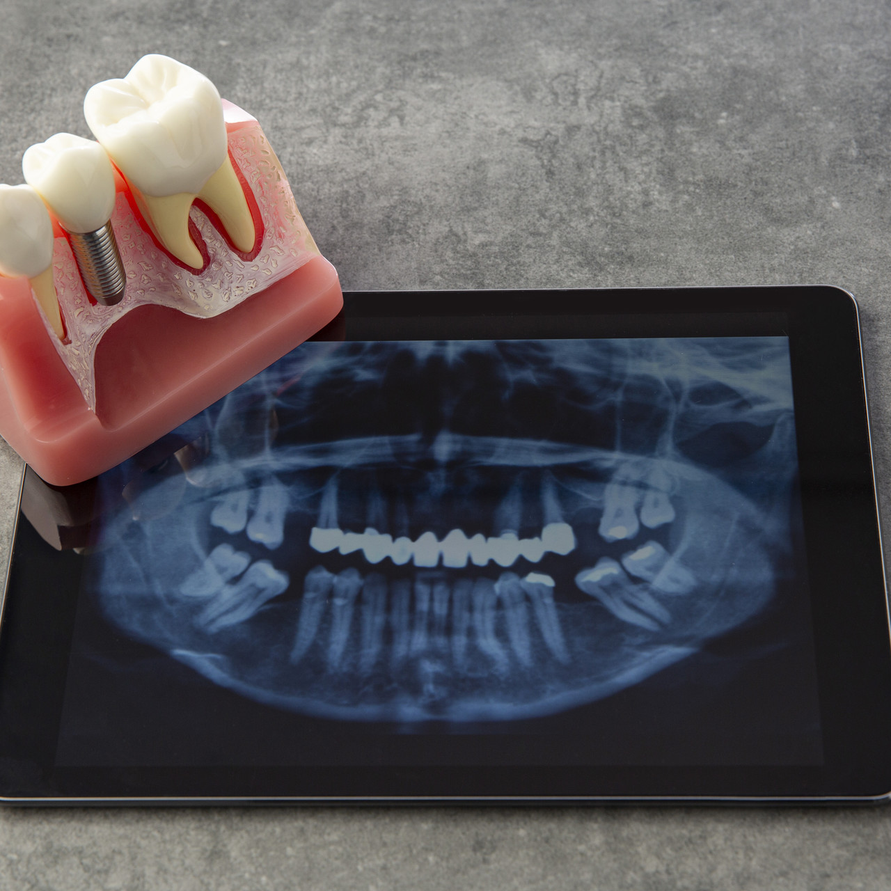 <p class="implant-tit"> 3D scanning</p><p class="implant-tsub"> By 3D scanning the patient's mouth, we identify exact tooth loss and implant insertion location.</p>