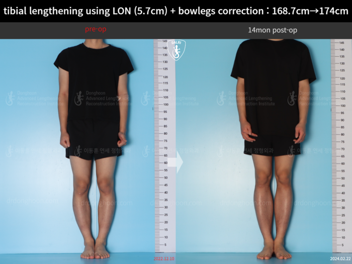 Tibial lengthening, 5.7 cm gained