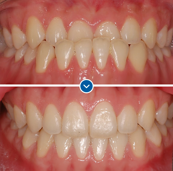 Teeth that bite backwards (crossbite)
