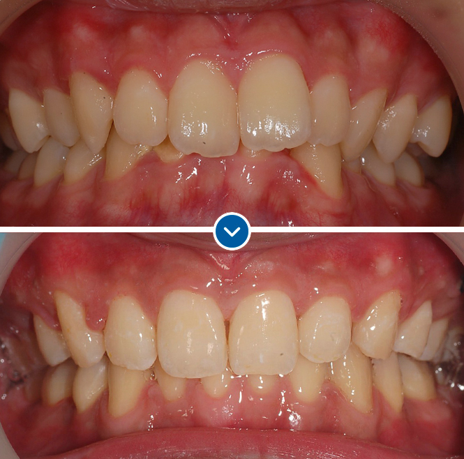  Deeply biting front teeth (overbite)