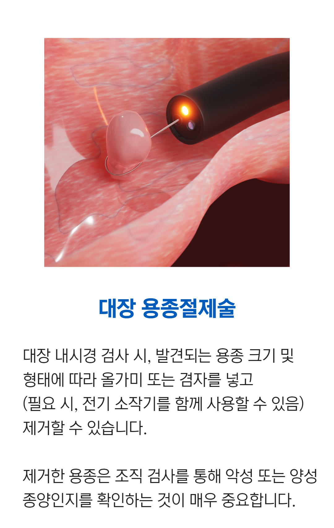 연세건강드림내과 용종절제술