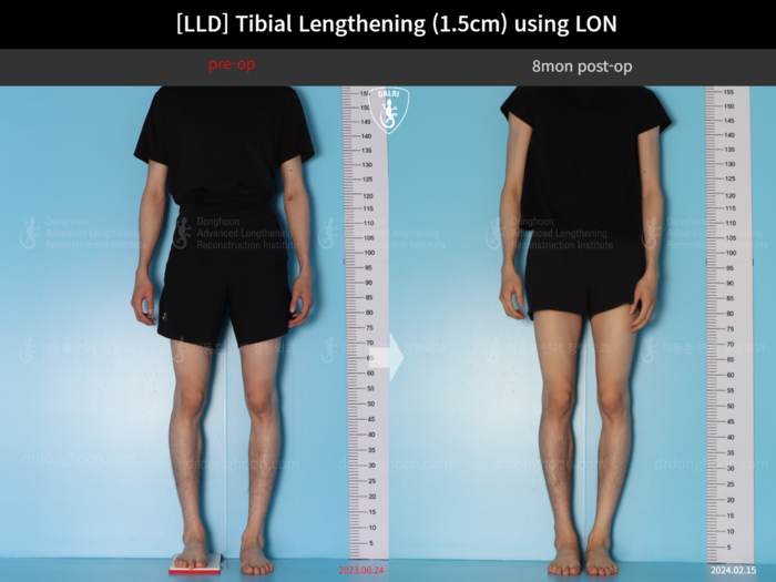 Tibial lengthening, 1.5 cm gained