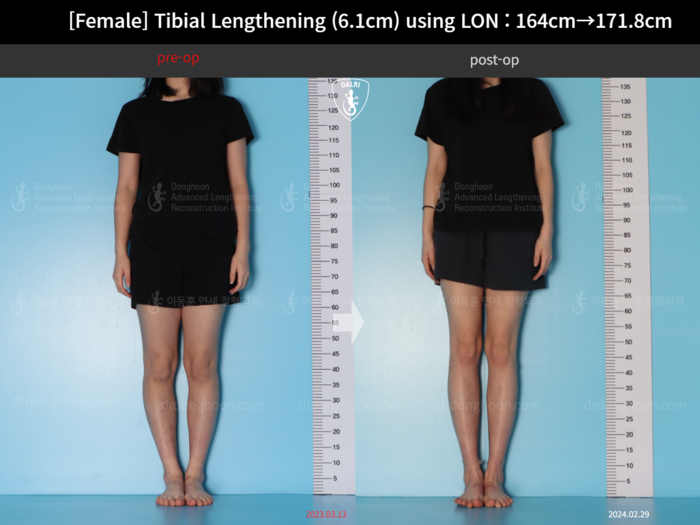 Tibial lengthening, 6.1 cm gained