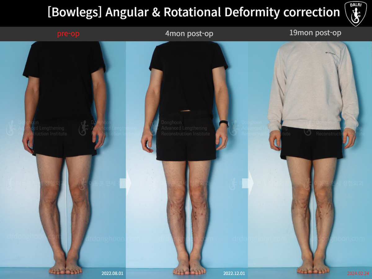 [Bowlegs] Angular & Rotational Deformity correction 4mon postop→