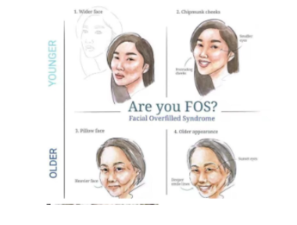 Facial Overfilled Syndrome (FOS): Understanding, Treating, and ...