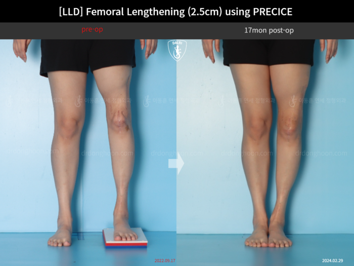Femoral lengthening, 2.5 cm gained