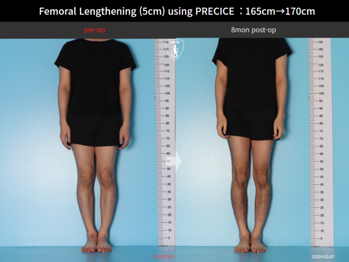 Femoral lengthening, 5 cm gained