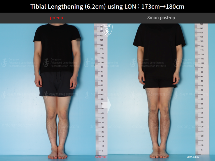 Tibial lengthening, 6.2 cm gained