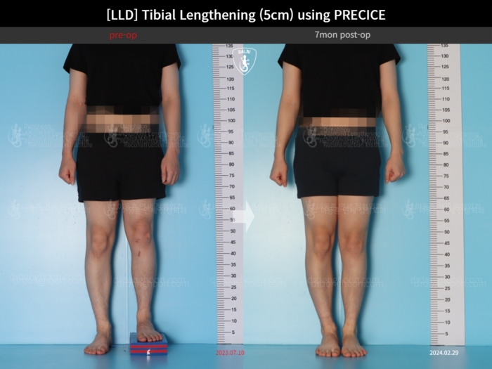 Tibial lengthening, 5 cm gained