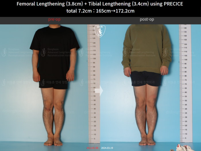 Femoral + tibial lengthening, 3.8 cm gained